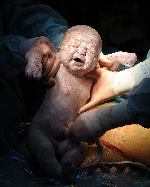 3f76ace8-fb0e-4e6e-97d7-4d388b1072bb_baby-being-born-caesarean-picture-suste-bonnen1