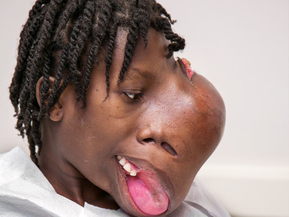 ht_face_tumor_removed_before_sr_140514_4x3_992