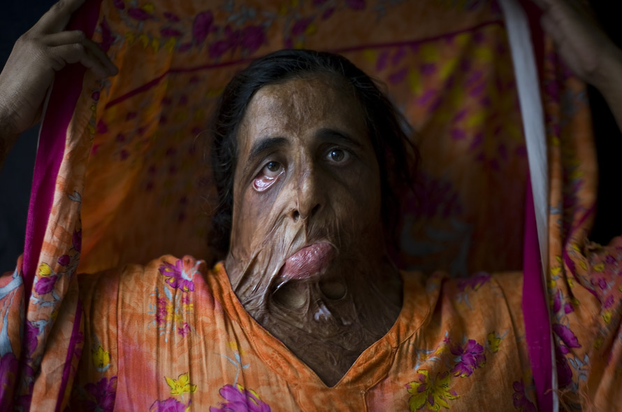 Shahnaz Bibi, 35, poses for a photograph in Lahore, Pakistan, Sunday, Oct. 26, 2008. Ten years ago Shahnaz was burnt with acid by a relative due to a familiar dispute. She has never undergone plastic surgery. (AP Photo/Emilio Morenatti)