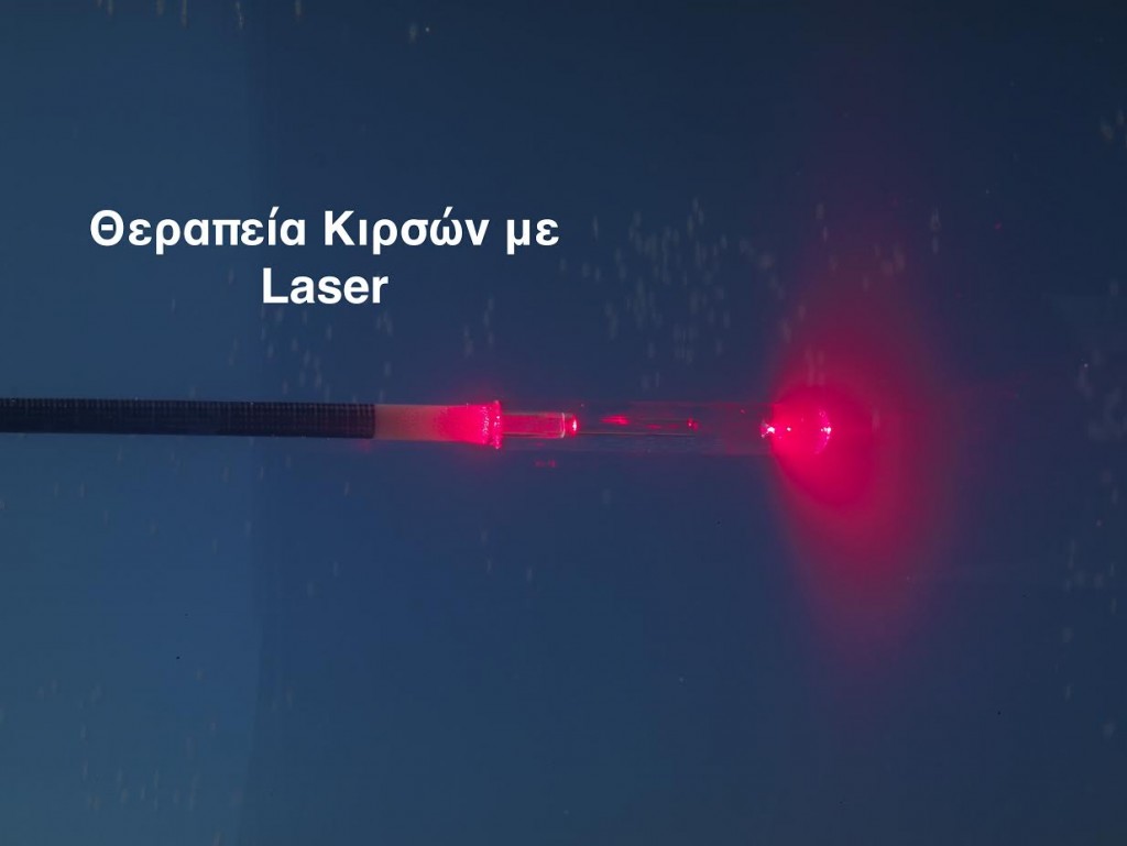 laser